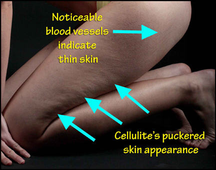 What Is Cellulite, And How We Can Remove It For Good? Can Be Fun For Anyone thumbnail